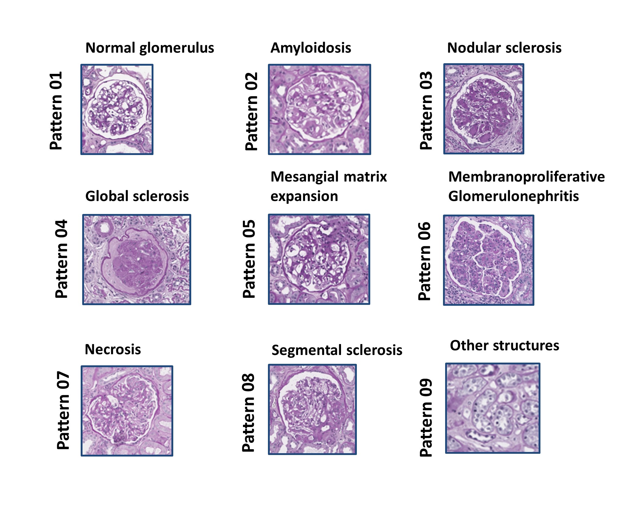 Assessment of glomerular morphological patterns by deep learning algorithms [Research Data]